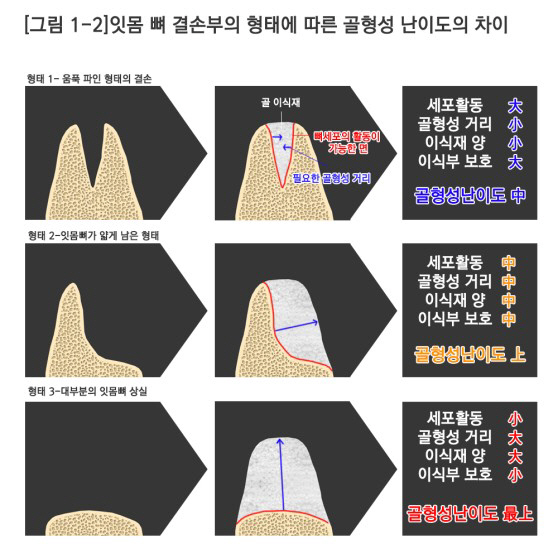 [치과 임플란트] 잇몸 뼈 부족 심하면 뼈부터 잘 만드는 것이 우선