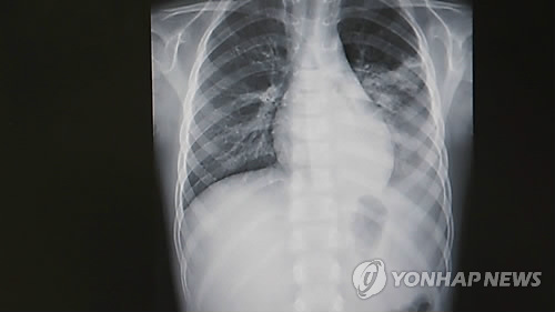 [이지 사이언스] 폐렴구균 백신 시장 뛰어드는 제약사들…예방 원리는
