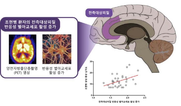 조현병 환자 뇌 '반응성 별아교세포' 활성 증가 최초 확인…치료제 개발 기여